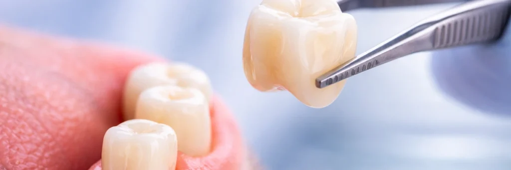 Dental restoration in Kitchener - custom dental crown