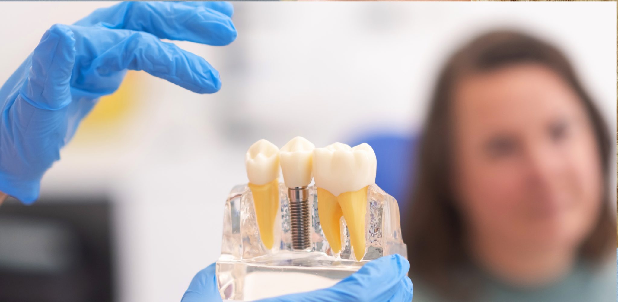 Home 6 Dental implants in Kitchener ON to restore missing teeth